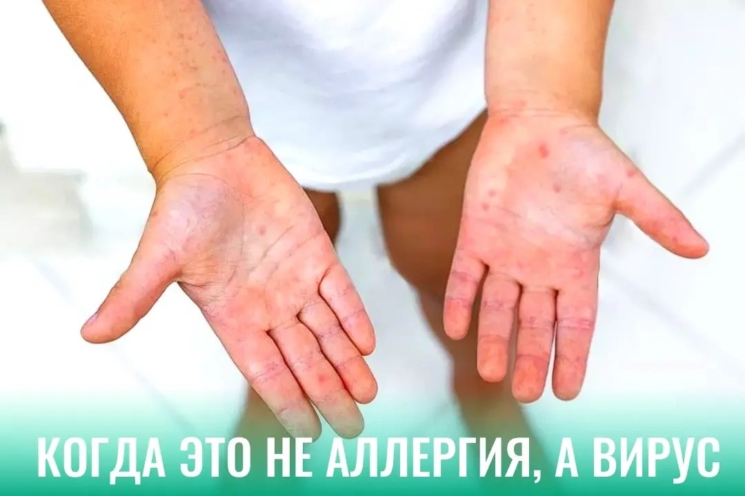 Лето и жара: как уберечь ребёнка от энтеровируса