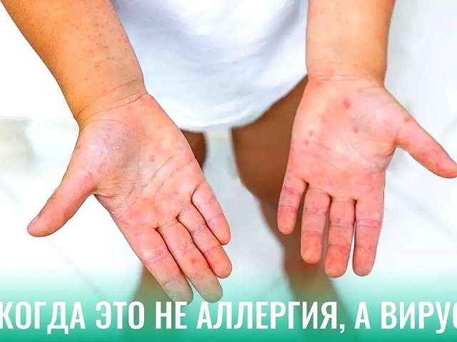 Лето и жара: как уберечь ребёнка от энтеровируса